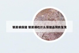 银屑病保健 银屑病吃什么保健品预防复发