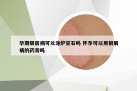 孕期银屑病可以涂炉甘石吗 怀孕可以用银屑病的药膏吗