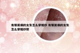 有银屑病的女生怎么穿婚纱 有银屑病的女生怎么穿婚纱照