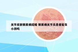 关节皮肤银屑病结婚 银屑病关节炎患者能生小孩吗