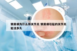 银屑病为什么得关节炎 银屑病引起的关节炎能活多久