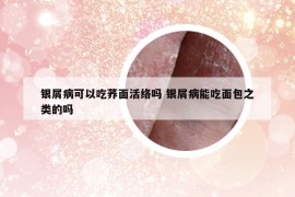 银屑病可以吃荞面活络吗 银屑病能吃面包之类的吗