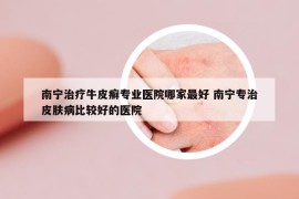 南宁治疗牛皮癣专业医院哪家最好 南宁专治皮肤病比较好的医院