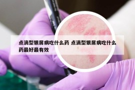 点滴型银屑病吃什么药 点滴型银屑病吃什么药最好最有效