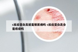 c反应蛋白高就是银屑病吗 c反应蛋白高会是癌症吗