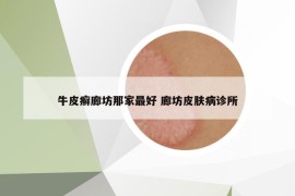 牛皮癣廊坊那家最好 廊坊皮肤病诊所