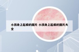 小孩身上起癣的图片 小孩身上起癣的图片大全