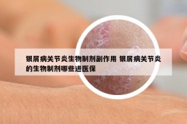 银屑病关节炎生物制剂副作用 银屑病关节炎的生物制剂哪些进医保