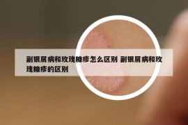 副银屑病和玫瑰糠疹怎么区别 副银屑病和玫瑰糠疹的区别