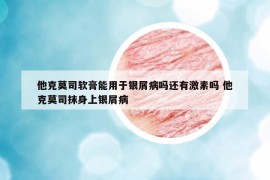 他克莫司软膏能用于银屑病吗还有激素吗 他克莫司抹身上银屑病