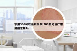 家用308可以治银屑病 308激光治疗银屑病管用吗