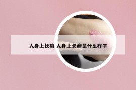 人身上长癣 人身上长癣是什么样子