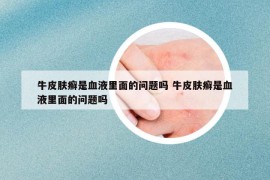 牛皮肤癣是血液里面的问题吗 牛皮肤癣是血液里面的问题吗