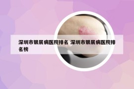 深圳市银屑病医院排名 深圳市银屑病医院排名榜