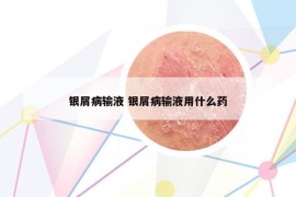 银屑病输液 银屑病输液用什么药