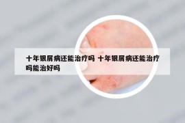 十年银屑病还能治疗吗 十年银屑病还能治疗吗能治好吗