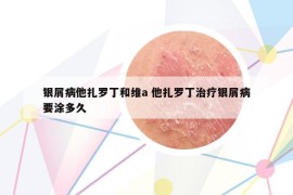 银屑病他扎罗丁和维a 他扎罗丁治疗银屑病要涂多久