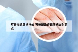 可善挺银屑病疗效 可善挺治疗银屑病会耐药吗