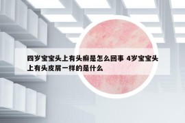 四岁宝宝头上有头癣是怎么回事 4岁宝宝头上有头皮屑一样的是什么