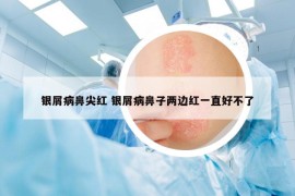 银屑病鼻尖红 银屑病鼻子两边红一直好不了