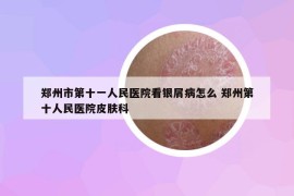 郑州市第十一人民医院看银屑病怎么 郑州第十人民医院皮肤科