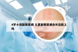 4岁小孩副银屑病 儿童副银屑病会长在脸上吗