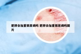 肥胖会加重银屑病吗 肥胖会加重银屑病吗图片