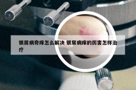 银屑病奇痒怎么解决 银屑病痒的厉害怎样治疗