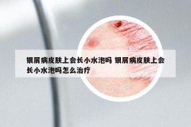 银屑病皮肤上会长小水泡吗 银屑病皮肤上会长小水泡吗怎么治疗