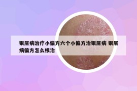 银屑病治疗小偏方六个小偏方治银屑病 银屑病偏方怎么根治