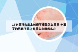 15岁男孩头皮上长癣不痒是怎么回事 十五岁的男孩子头上都是头皮癣怎么办