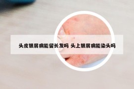 头皮银屑病能留长发吗 头上银屑病能染头吗