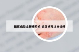 银屑病能吃新癀片吗 银屑病可以补锌吗