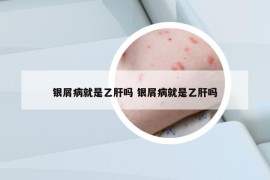 银屑病就是乙肝吗 银屑病就是乙肝吗