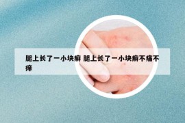 腿上长了一小块癣 腿上长了一小块癣不痛不痒