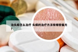 治头癣怎么治疗 头癣的治疗方法有哪些偏方?