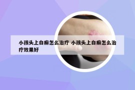 小孩头上白癣怎么治疗 小孩头上白癣怎么治疗效果好