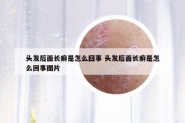 头发后面长癣是怎么回事 头发后面长癣是怎么回事图片