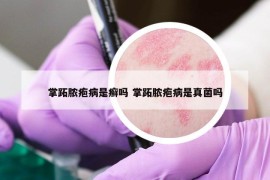 掌跖脓疱病是癣吗 掌跖脓疱病是真菌吗