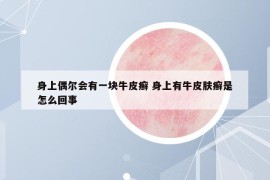 身上偶尔会有一块牛皮癣 身上有牛皮肤癣是怎么回事