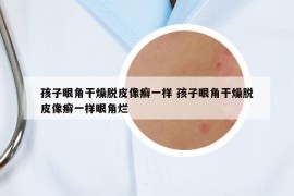 孩子眼角干燥脱皮像癣一样 孩子眼角干燥脱皮像癣一样眼角烂