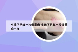 小孩下巴红一片像是癣 小孩下巴红一片像是癣一样