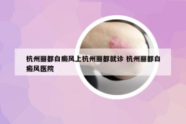 杭州丽都白癜风上杭州丽都就诊 杭州丽都白瘢风医院