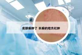 皮肤癣肿了 长癣的地方红肿