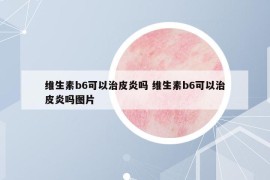 维生素b6可以治皮炎吗 维生素b6可以治皮炎吗图片