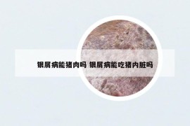 银屑病能猪肉吗 银屑病能吃猪内脏吗