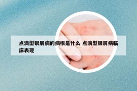 点滴型银屑病的病根是什么 点滴型银屑病临床表现