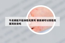 牛皮癣能不能抹他克莫司 银屑病可以擦他克莫司软膏吗