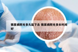 银屑病照光多久能下去 银屑病照光多长时间好