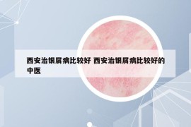 西安治银屑病比较好 西安治银屑病比较好的中医